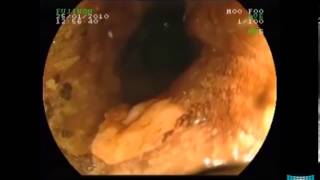 Advanced Endoscopic Imaging for Characterization of Heterotopic Gastric Mucosa in the Esophagus [upl. by Mona913]