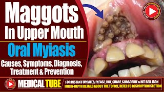 Maggots in Upper Mouth  Oral Myiasis  Causes Diagnosis and Treatment [upl. by Stavro]