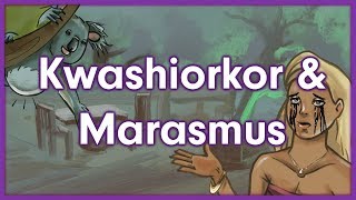 Kwashiorkor vs Marasmus  Nutrition Mnemonic [upl. by Meirrak263]