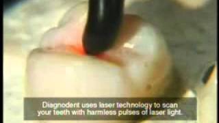 Diagnodent  dental caries laser detector  Minh Nguyen DDS [upl. by Liu356]