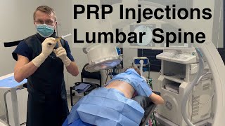 Natural Back Pain amp Sciatica Treatment with PRP Injections  The Alternative to Steroids and Surgery [upl. by Bruning423]