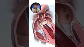 Incredible Aortic TAVI Animation Visual Explanation of Heart Procedure [upl. by Desma]