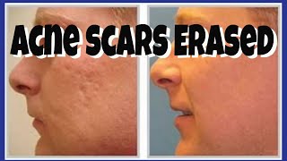 HOW TO COVER ACNE SCARS FLAWLESSLY  Tutorial  CHRIS GIBSON [upl. by Siaht]