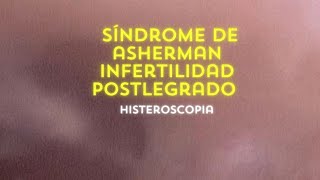 Síndrome de Asherman  Infertilidad Post legrado Histeroscopia [upl. by Sheya]