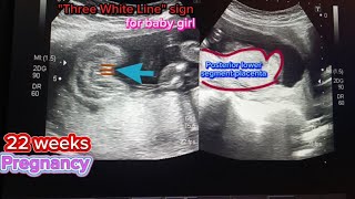 baby girl with posterior placenta [upl. by Hannan]