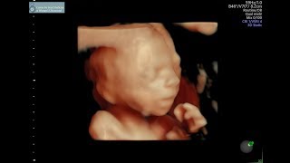 20 week ultrasound [upl. by Aliuqahs]