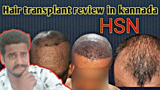 Hair transplant in kannada  HSN Bangalore [upl. by Tare]