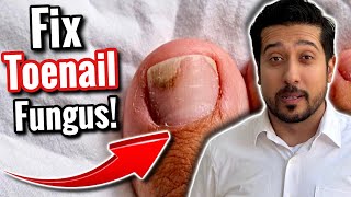 How to Get Rid of Toenail Fungus  The SCIENCE of Toenail Fungi Removal [upl. by La531]