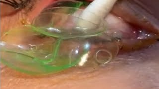 Doctor removes 23 contact lenses from patients eye [upl. by Gabe]