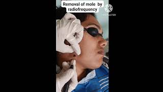 Removal of mole by radiofrequency I Skin Care [upl. by Eila]