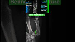 Thumb Fracture  Bennett’s fracture shorts radiology xray trauma [upl. by Rachaba976]