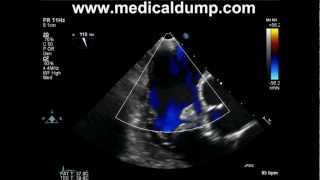 Tricuspid Valve Fibroelastoma  TransEsophageal Echocardiography TEE [upl. by Haliehs46]