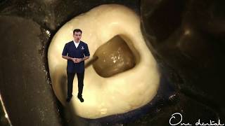 Detailed demonstration of access opening for mandibular second molar [upl. by Eikin827]