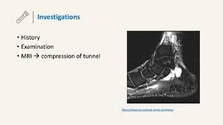 Tarsal Tunnel Syndrome [upl. by Anilef790]