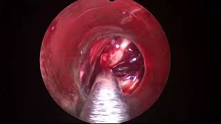 Endoscopic Intraventricular Clot Evacuation [upl. by Acinorrev]