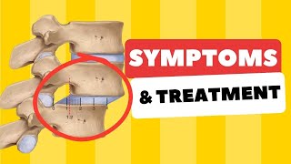 Spondylolisthesis Symptoms and Treatment on a Real Patient Brad [upl. by Nollek721]