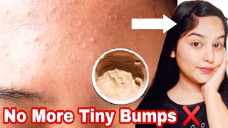 No More Tiny Bumps On Face  Magical Face pack For Tiny Bumps on Forehead shorts skincare diy [upl. by Marga]