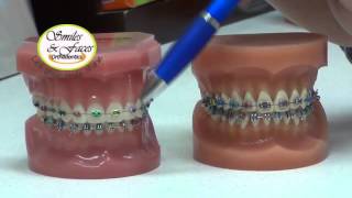 Braces type made simple Introducing Metal Minibraces with Colours [upl. by Ainoloppa]