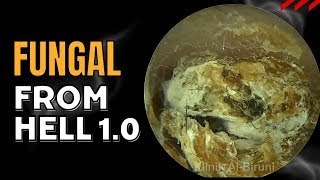 Fungal From Hell Version 10 Earwax Removal in 2024  Mr Chea Official [upl. by Eerpud664]