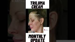 Tri Luma cream Before and After pictures [upl. by Anilatsyrc]