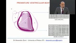 Arrhythmogenic right ventricular cardiomyopathy AZorzi [upl. by Lac]