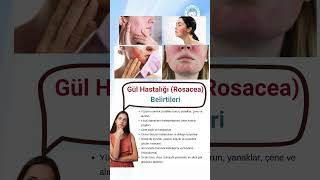 Gül Hastalığına Dair Bilgiler Sağlıklı Bir Cilt İçin Adımlar gülhastalıgı belirtiler rosacea [upl. by Nymassej186]