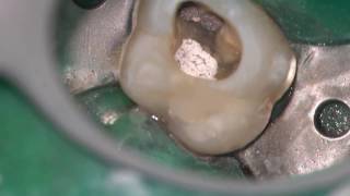 Resorption Nonsurgical Treatment of a Molar with complete narrative [upl. by Enixam]