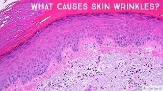 What Sun does to your skin…seen under the microscope skin wrinkles solar elastosis dermatology [upl. by Ahtelra]