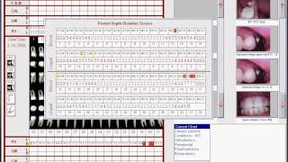 Perio Charting Part 2 [upl. by Naot]