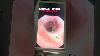 Understanding Stomach Ulcers An InDepth Look Under Endoscopy [upl. by Ztnaj231]