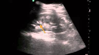 Medullary Sponge Kidney POCUS [upl. by Raul804]