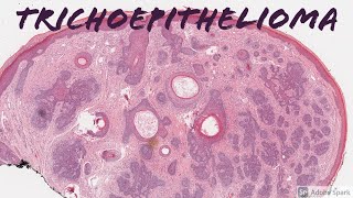 Trichoepithelioma 101 [upl. by Thgiwed]