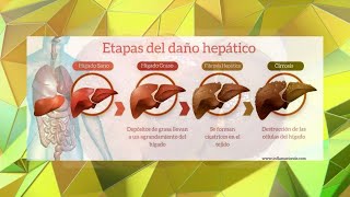 Etapas del daño por hepatomegalia ¿Qué significa el agrandamiento del hígado [upl. by Bathsheba]