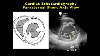 Echo Parasternal Short Axis View PSAX [upl. by Radman]