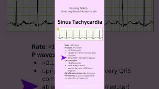 Sinus Tachycardia EKG ECG Rhythm Nursing Review in 60 Seconds shorts ecg nursing [upl. by Schreibe]