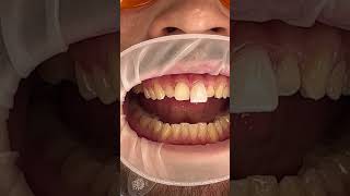 Veneers Process [upl. by Airehtfele876]