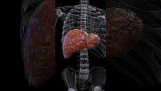 🟡 Understanding Liver Cirrhosis The Silent Damage 🟡 [upl. by Namwob]