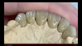 Zirconia Singles Anterior New Technique [upl. by Daegal272]