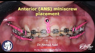 Anterior miniscrew ANS placement step by step by dr Ahmed Adel Orthodontics [upl. by Innek59]