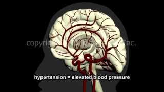 What Is A Stroke  Narration and Animation by Dr Cal Shipley MD [upl. by Yvon]