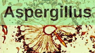 Aspergillus and Aspergillosis  Pathology mini tutorial [upl. by Aetnahc]