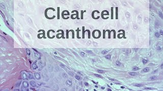 Clear Cell Acanthoma  Pathology mini tutorial [upl. by Aineles]