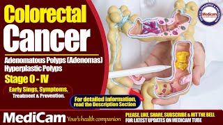 Colorectal Cancer Sings Symptoms And Treatment [upl. by Goda]