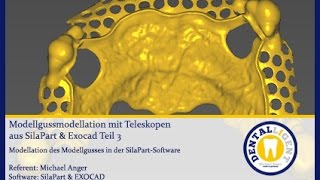 Modellgussmodellation mit Teleskopen aus SilaPart amp Exocad Teil 3 [upl. by Nanette706]