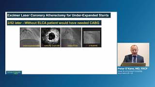 Role of laser atherectomy in coronary in stent re stenosis ISR [upl. by Suoivart461]