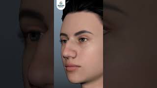 Recovery Period After Rhinoplasty Surgery rhinoplastyrecovery [upl. by Fleda]