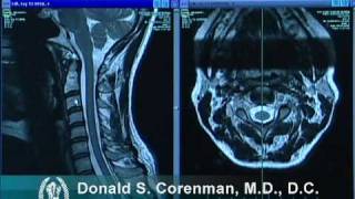 How to Read a MRI of the Normal Cervical Spine Neck  Colorado Spine Expert [upl. by Atul]