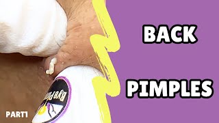 Extraction of back pimplesRelax with bye pimple💜pimple blackheads acne asmr [upl. by Kotz38]