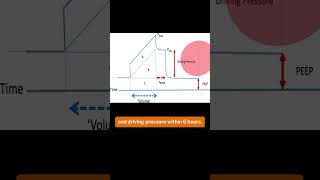 Time Standardised Management of ARDS [upl. by Alexina339]