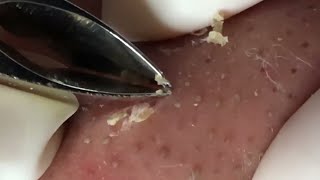 Precision Pore Purge Expert Tweezer Blackhead Extractions [upl. by Seuqramed]